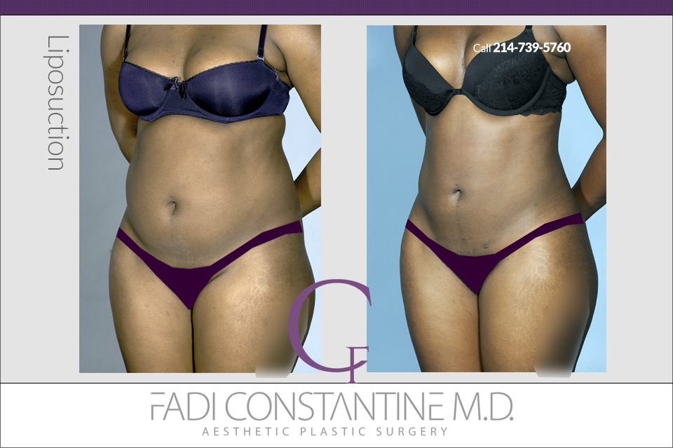 Dallas Body Contouring Surgery - Lipo Dallas - Dallas Liposuction