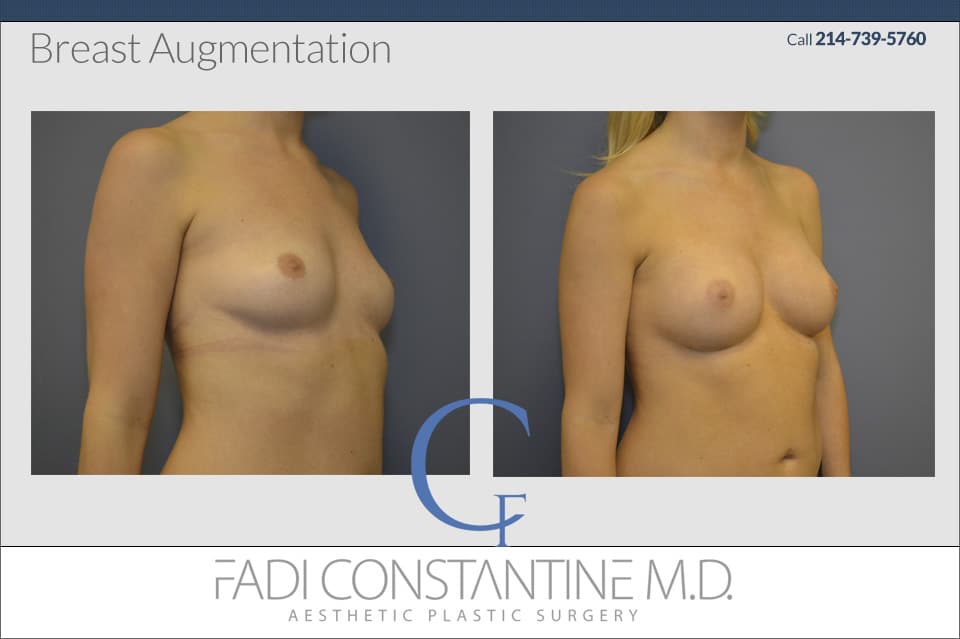 Dallas Breast Augmentation