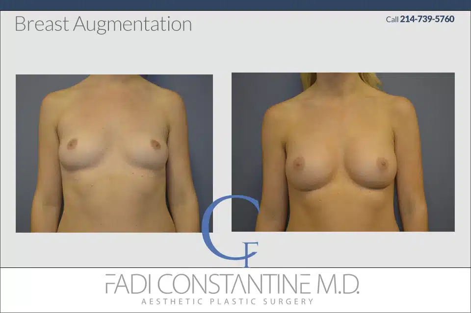 breast Augmentation in Dallas