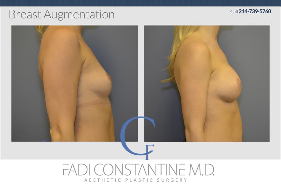 The Secret to a Beautiful Breast Augmentation - Carp Cosmetic