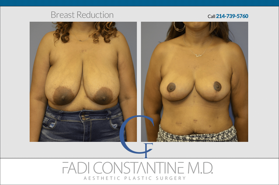 Breast Reduction Before and After Results