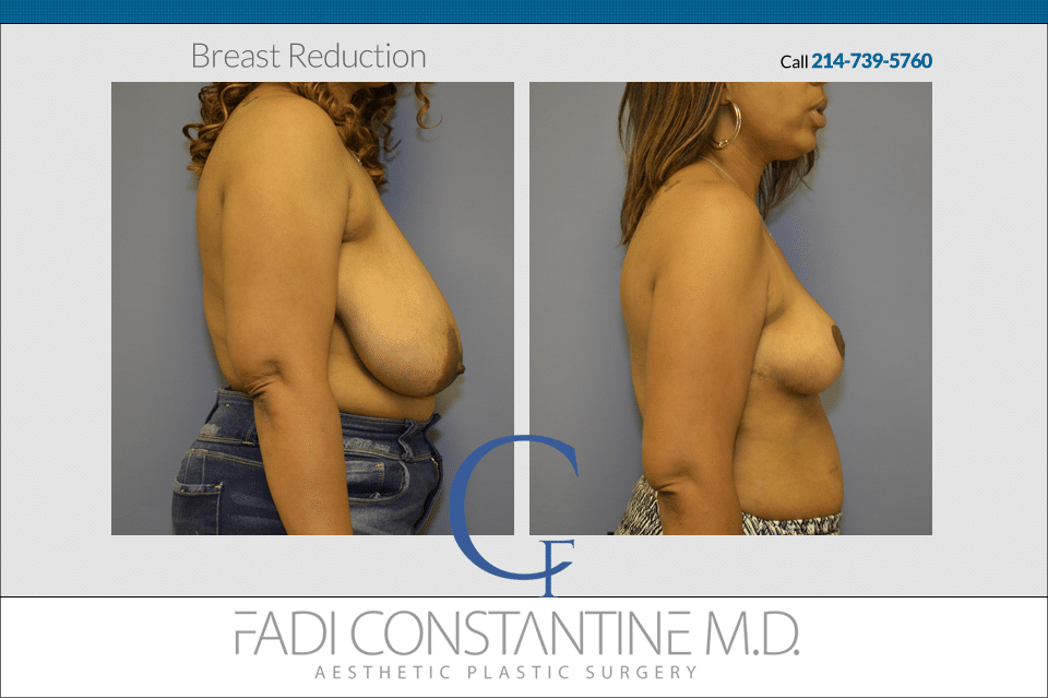 Great Result in a Breast Reduction