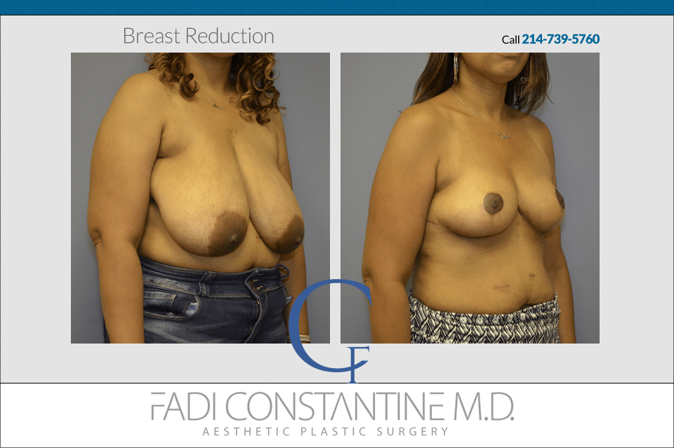 Breast Reduction at Constantine Plastic Surgery Center