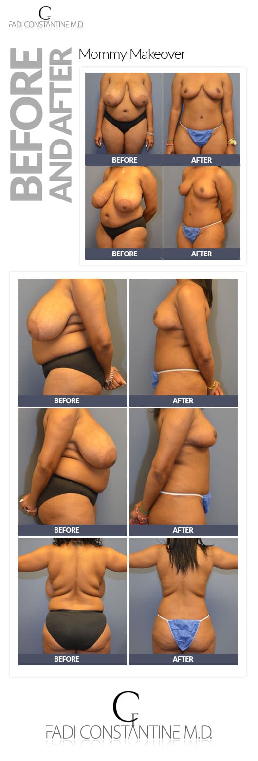 Breast Reduction Dallas