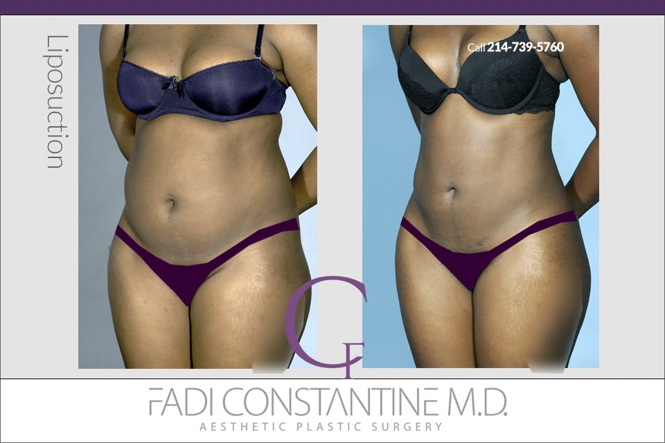 Body Contouring - Constantine Plastic Surgery