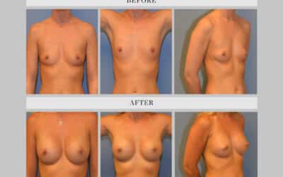 Breast Augmentation Before And After Case Study With 275cc Round Silicone