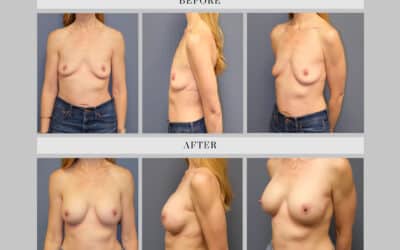 Breast Augmentation Before And After Case Study With 345cc Round Silicone