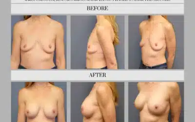Breast Augmentation Before And After Case Study With 345cc Round Silicone
