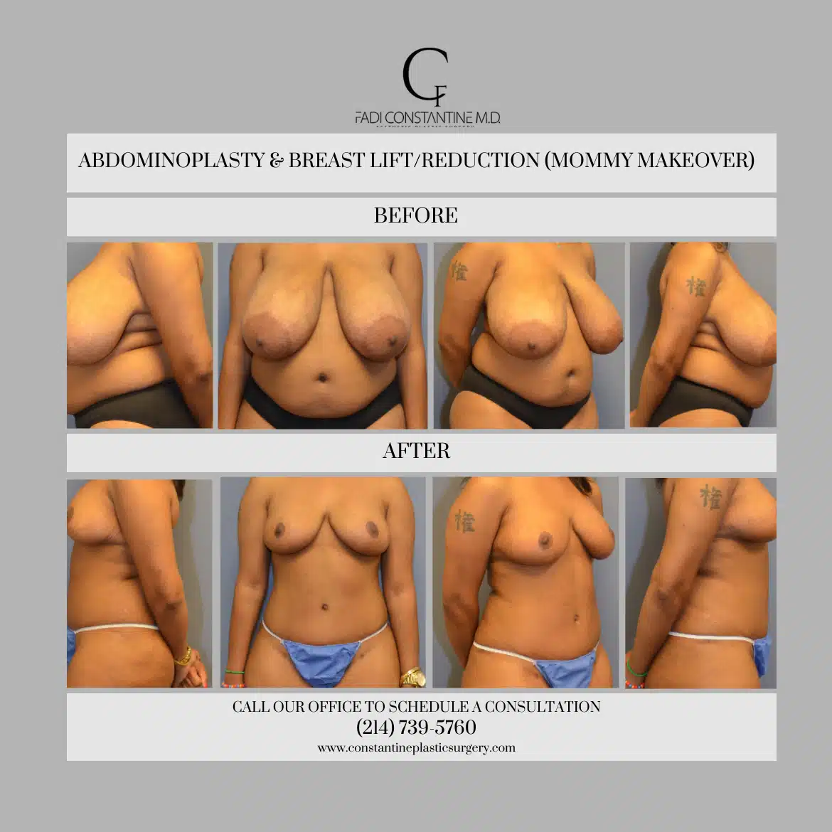 Does a Breast Lift Reduce Cup Size?