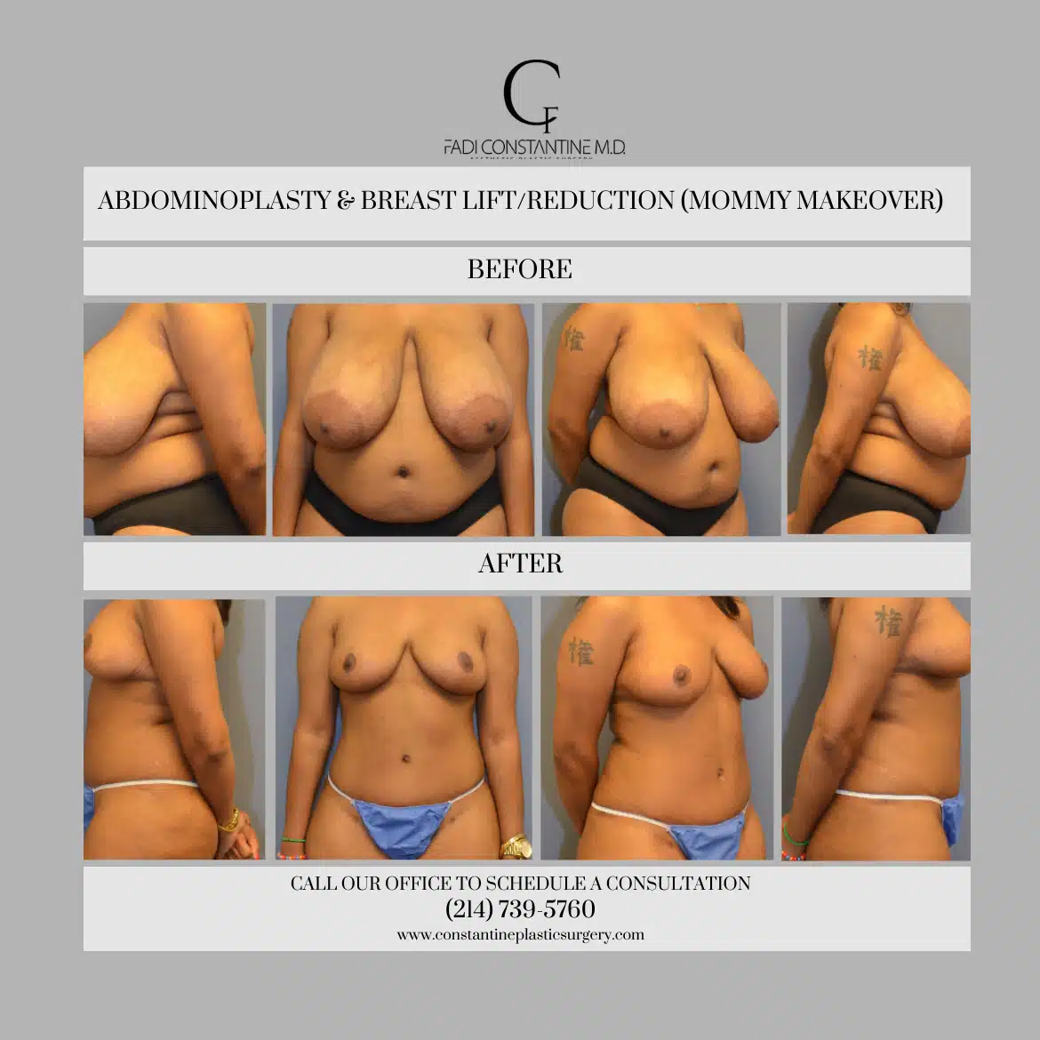 Full Body Lift Surgery Before & After Photo Gallery - Orange County