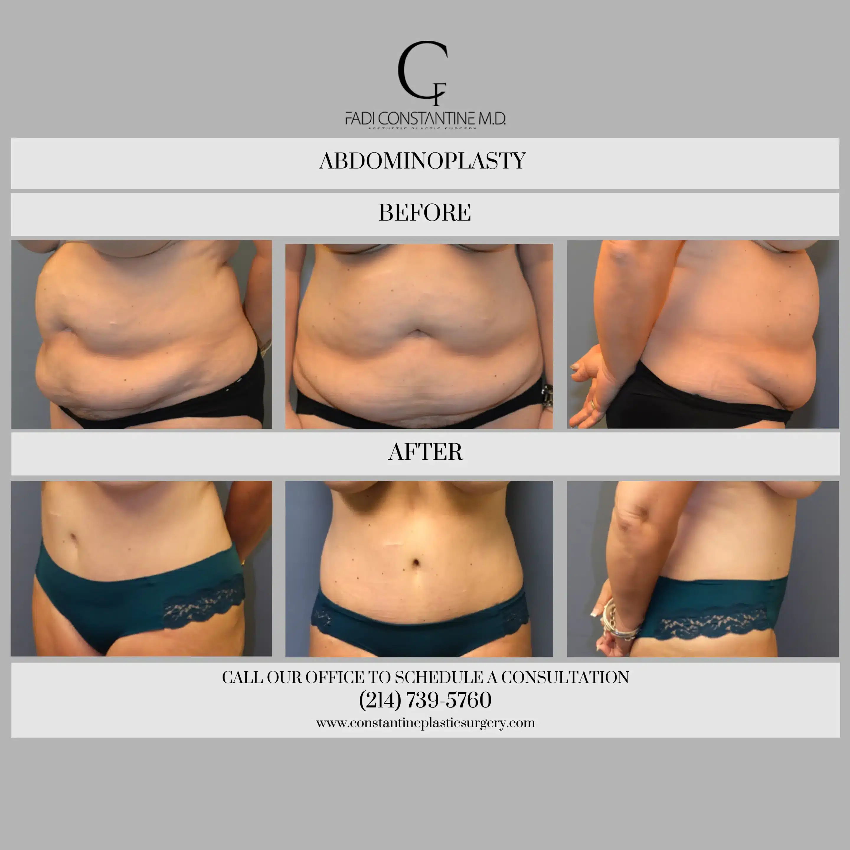 https://constantineplasticsurgery.com/wp-content/uploads/2023/09/Constantine-Plastic-Surgery-Body-Contouring-Abdominoplasty-Before-After-Gallery-Dallas-Texas-scaled.webp
