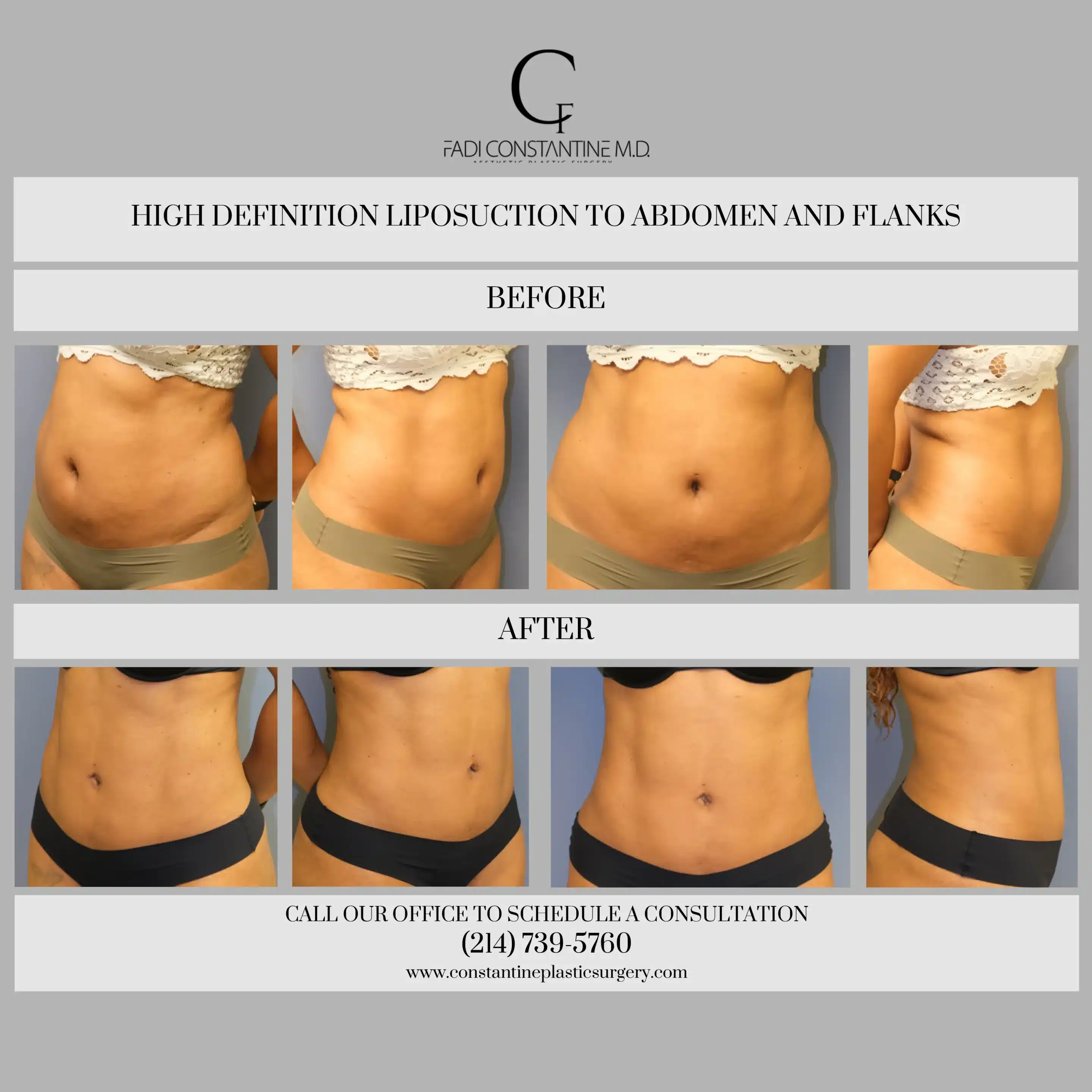 Liposuction / Liposculpture – Constantine Cosmetic Surgery