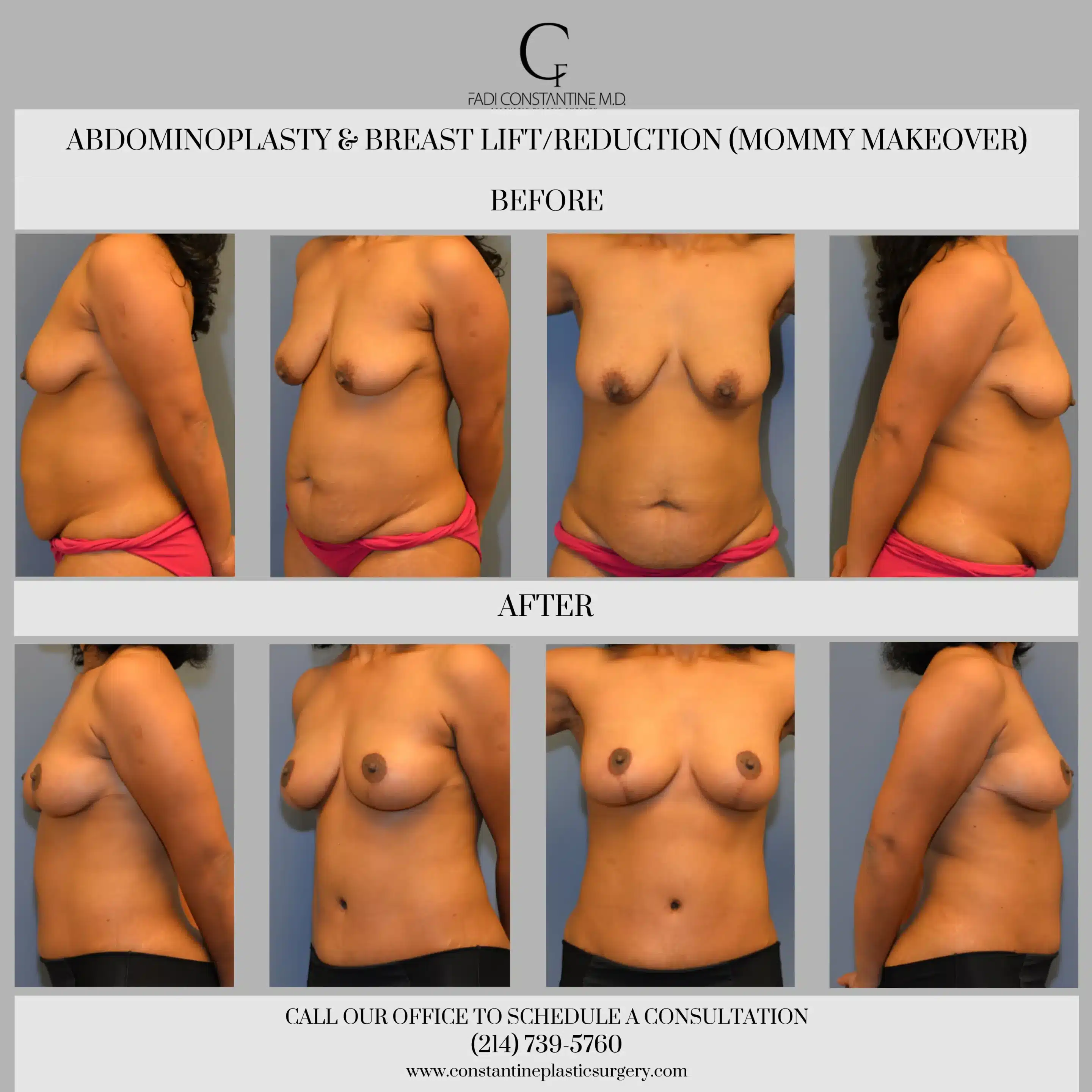 Is a Breast Lift is the Solution to Pregnancy Breast Changes