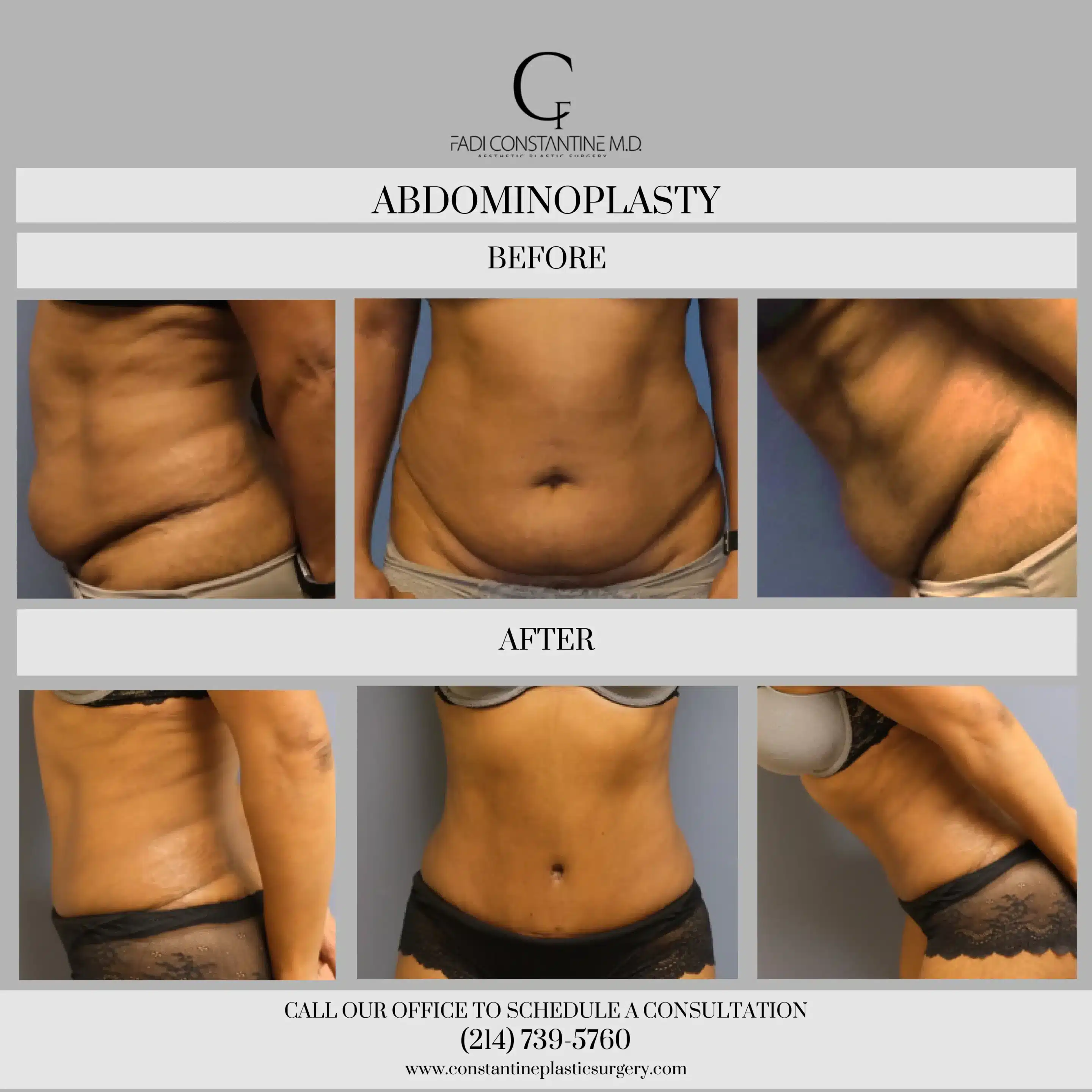 Abdominoplasty Post Op Case #74383 - The Plastic Surgery Group